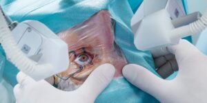 Signs, Types, and other Facts about Cataracts Surgery